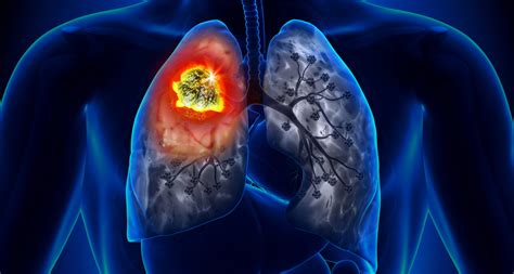 Lungenkrebs bei asiatisch-amerikanischen Frauen trotz Nichtrauchens
