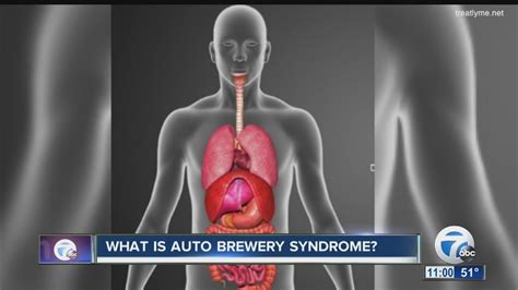 Rare Auto-Brewery Syndrome: A Medical Mystery Unraveled