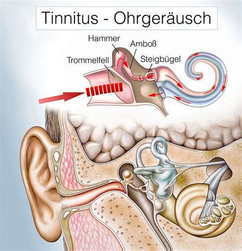 Die Wissenschaft hinter Tinnitus: Neue Erkenntnisse und persönliche Erfahrungen